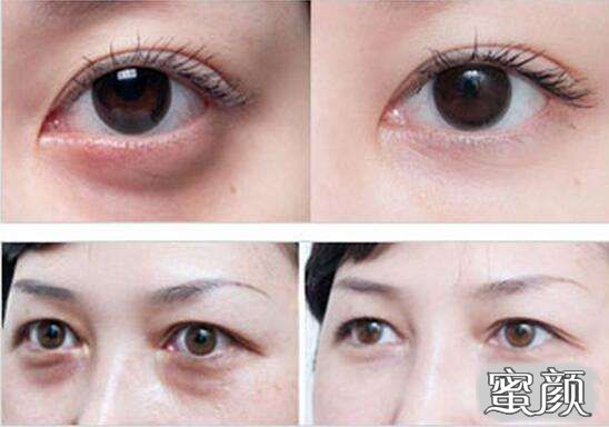 科技揭秘，最新去眼袋最佳方法，重塑眼部美麗新篇章！